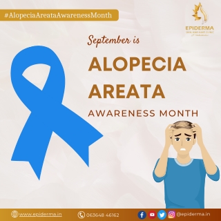 September is Alopecia Areata Awareness Month -  Epiderma Clinic