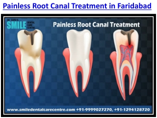 Painless Root Canal Treatment in Faridabad at Smile Dental