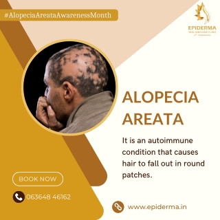 What is Alopecia Areata | Best Dermatology Centre in Jayanagar | Epiderma Clinic