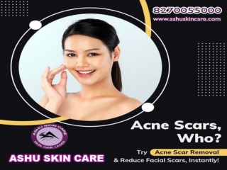 ashu skin care is best for  acne scar treatment clinic in bhubaneswar, odisha