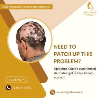 Alopecia areata Problem | Best Dermatology Centre in Jayanagar | Epiderma Clinic