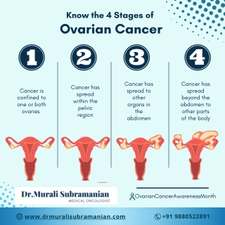 4 stages of Ovarian Cancer, Best Medical Oncologist in Kalyan Nagar