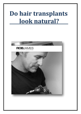 Do hair transplants look natural