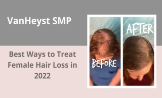 Best Ways to Treat Female Hair Loss in 2022