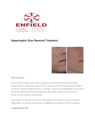 Hypertrophic Scar Removal Treatment