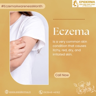 What is Eczema | Best Skin Clinic in Jayanagar | Epiderma Clinic