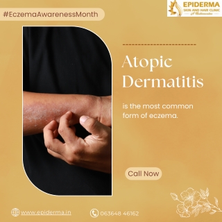 Atopic Dermatitis | Best Skin Clinic in Jayanagar | Epiderma Clinic