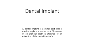 Dental Implants.