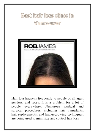 Best hair loss clinic in vancouver