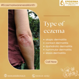 Types of Eczema | Best Skin Clinic in Jayanagar | Epiderma Clinic