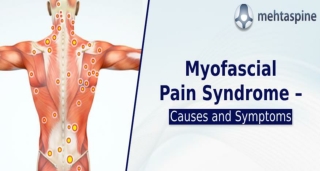 Myofascial Pain Syndrome – Causes and Symptoms| Mehta Spine