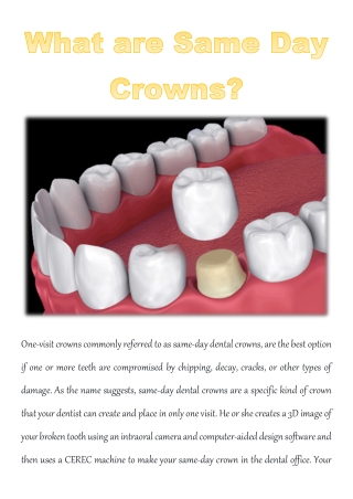 What are Same Day Crowns