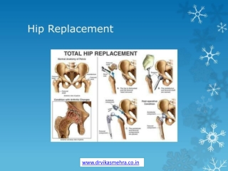 Hip Replacement Surgery