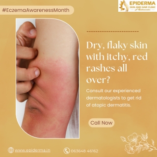 Having dry, flaky skin with itchy - Skin Clinic in Jayanagar - Epiderma Clinic