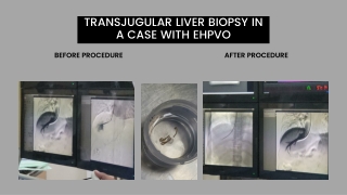 Transjugular Liver Biopsy in a Case with EHPVO