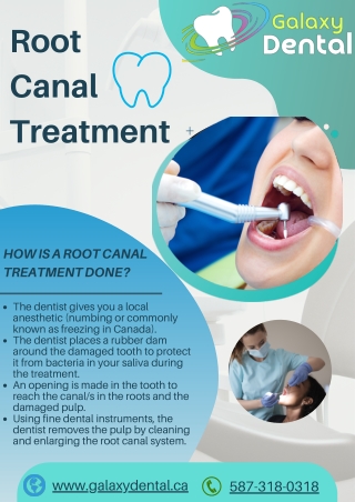 Root Canal Treatment Calgary | Certified Dentists - Galaxy Dental