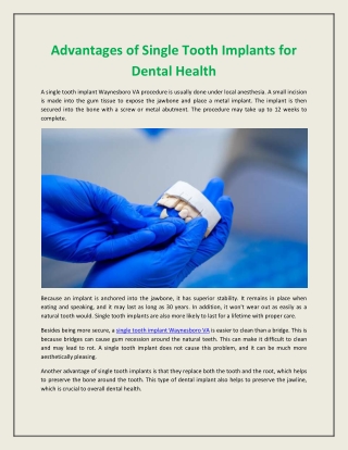 Advantages of Single Tooth Implants for Dental Health