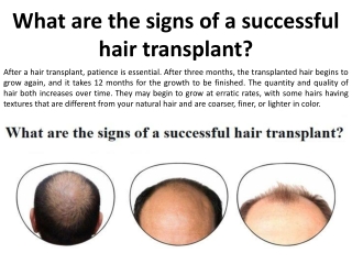 What hair transplant procedures in Singh have had the most success?