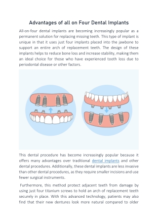 Advantages of all on Four Dental Implants