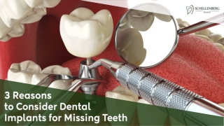 3 Reasons to Consider Dental Implants for Missing Teeth