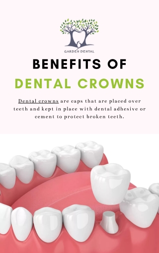 Benefits Of Dental Crowns