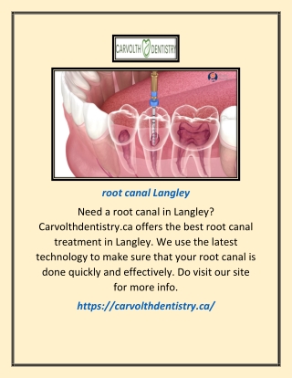 Root Canal Langley | Carvolthdentistry.ca