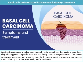 Basal Cell Carcinoma and its New Revolutionary Treatment