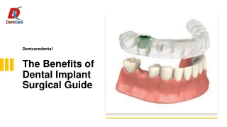 The Benefits of Dental Implant Surgical Guide