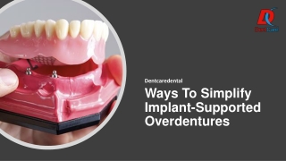 Ways To Simplify Implant-Supported Overdentures