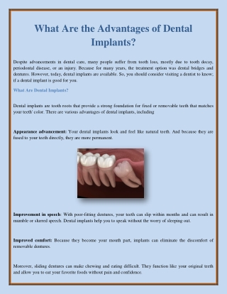What Are the Advantages of Dental Implants?
