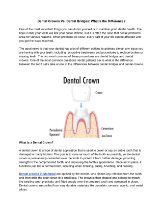 Dental Crowns Vs. Dental Bridges: What’s the Difference?