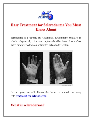 Easy Treatment for Scleroderma You Must Know About