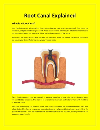 Root Canal Explained