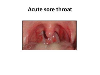 Acute sore throat, Infection and treatment - Dr Sheetu Singh Chest Expert in Jaipur