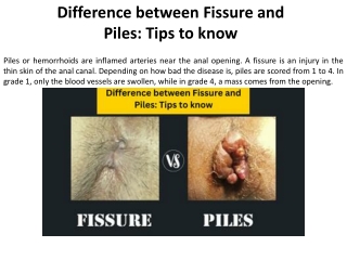 Tips for telling the difference between Fissures and Piles
