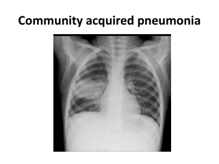 Community acquired pneumonia and Bronchiolitis reports by Dr Sheetu Singh lungs Expert in Jaipur