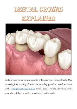 Dental Crowns Explained