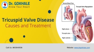 Tricuspid Valve Disease Causes and Treatment | Dr Gokhale