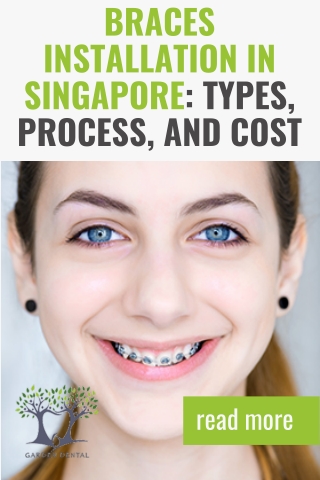 Braces Installation in Singapore Types, Process, and Cost