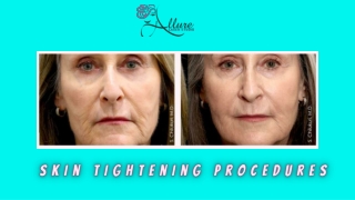 Skin Tightening Procedures - ALLURE LASER STUDIO