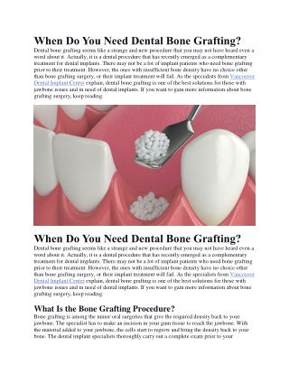 When Do You Need Dental Bone Grafting