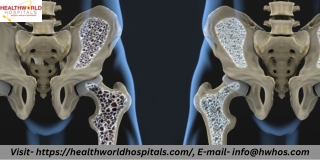 What brings about osteoporosis  HealthWorldHospitals