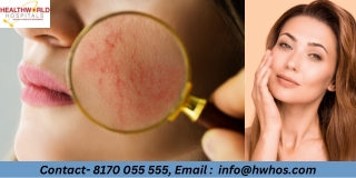 Treatments For Acne Suggested By Our Dermatologists  HealthWorldHospitals
