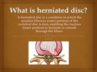 What is herniated disc?