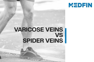 Varicose Veins Vs Spider Veins | Leg Vein Treatment | Medfin