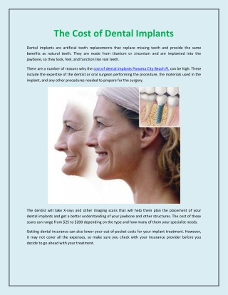The Cost of Dental Implants