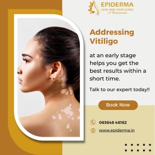 Address Vitiligo at an early stage - Skin Clinic in Jayanagar - Epiderma Clinic