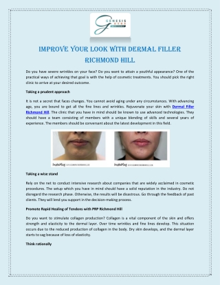 Improve Your Look with Dermal Filler Richmond Hill