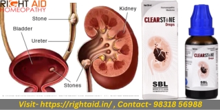 What Are Kidney Stones' Early Warning Signs or Symptoms  RightAid