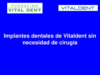 Implantes dentales de Vitaldent sin necesidad de cirugía